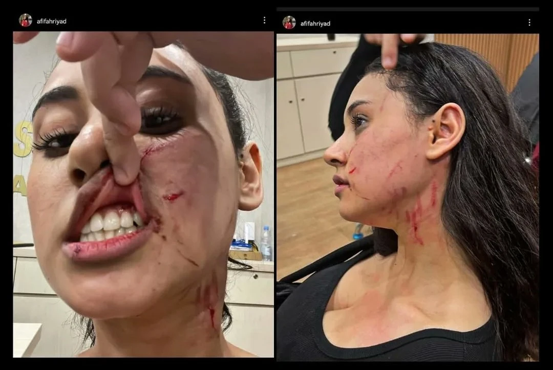 Foto: Viral Selebgram Afifah Riyad Jadi Korban Penganiayaan Mantan Pacar Suami | Pifa Net